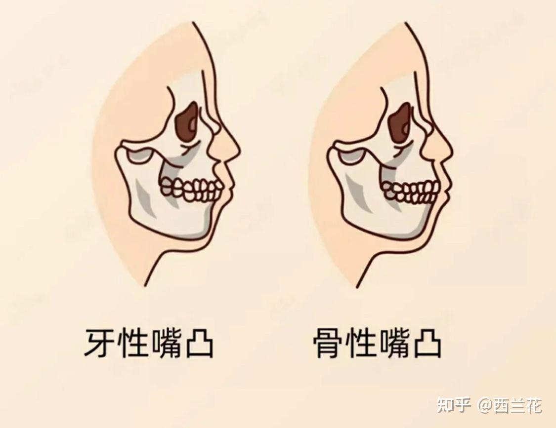 牙性和骨性嘴凸对比照图片