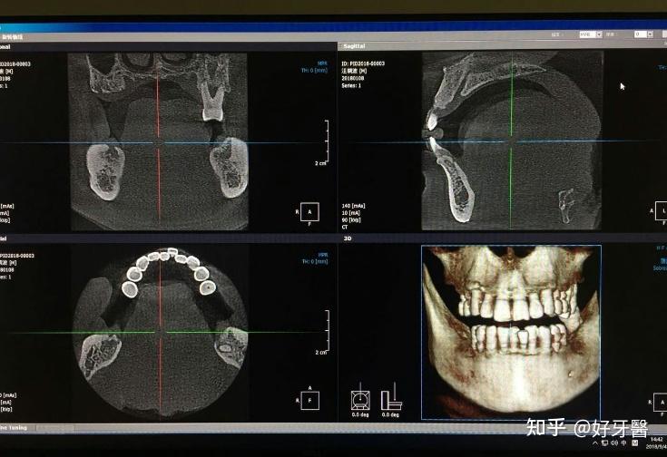 能夠360度觀察每顆牙齒及牙根健康狀況,以及牙齒的整體協調關係2,側位