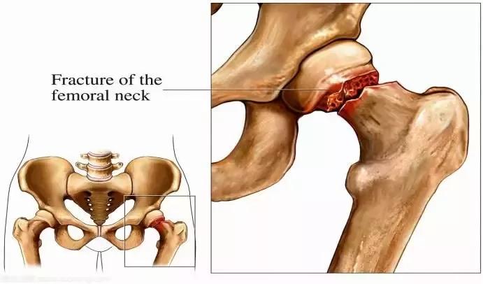 股骨颈骨折分型解剖图图片