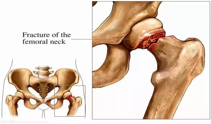 高龄老人越来越多股骨颈骨折时常发生布骨告诉你它的危害到底有多大
