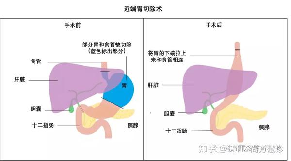 一文读懂胃癌的手术治疗 知乎