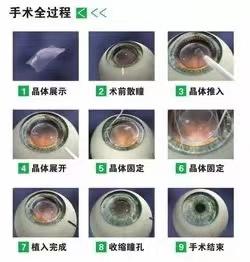 成都icl晶体植入手术是什么 为什么眼科医生不做近视手术 知乎
