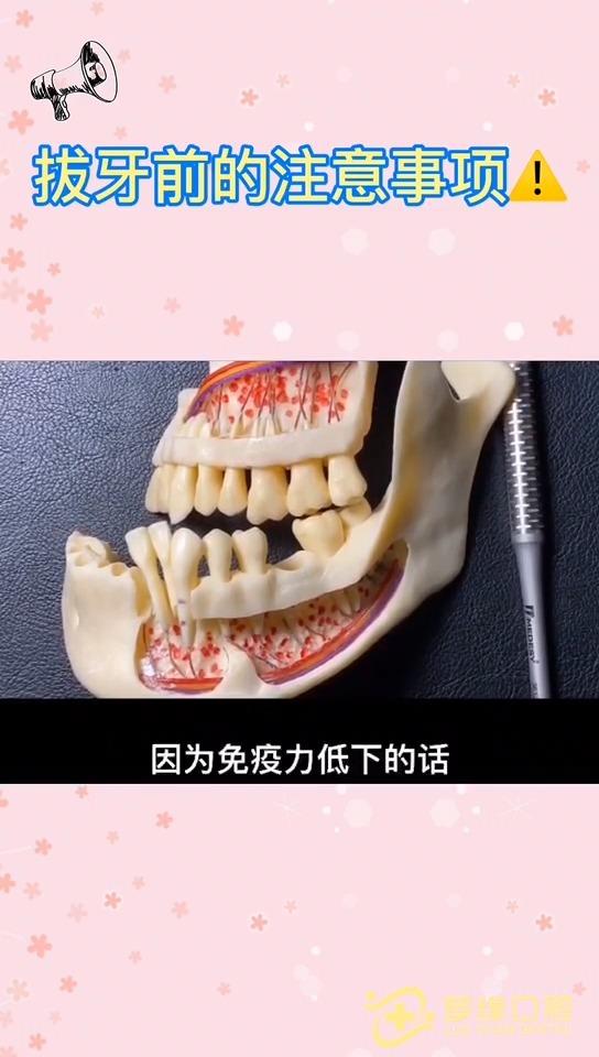 4智齿不疼拔不拔邹医生