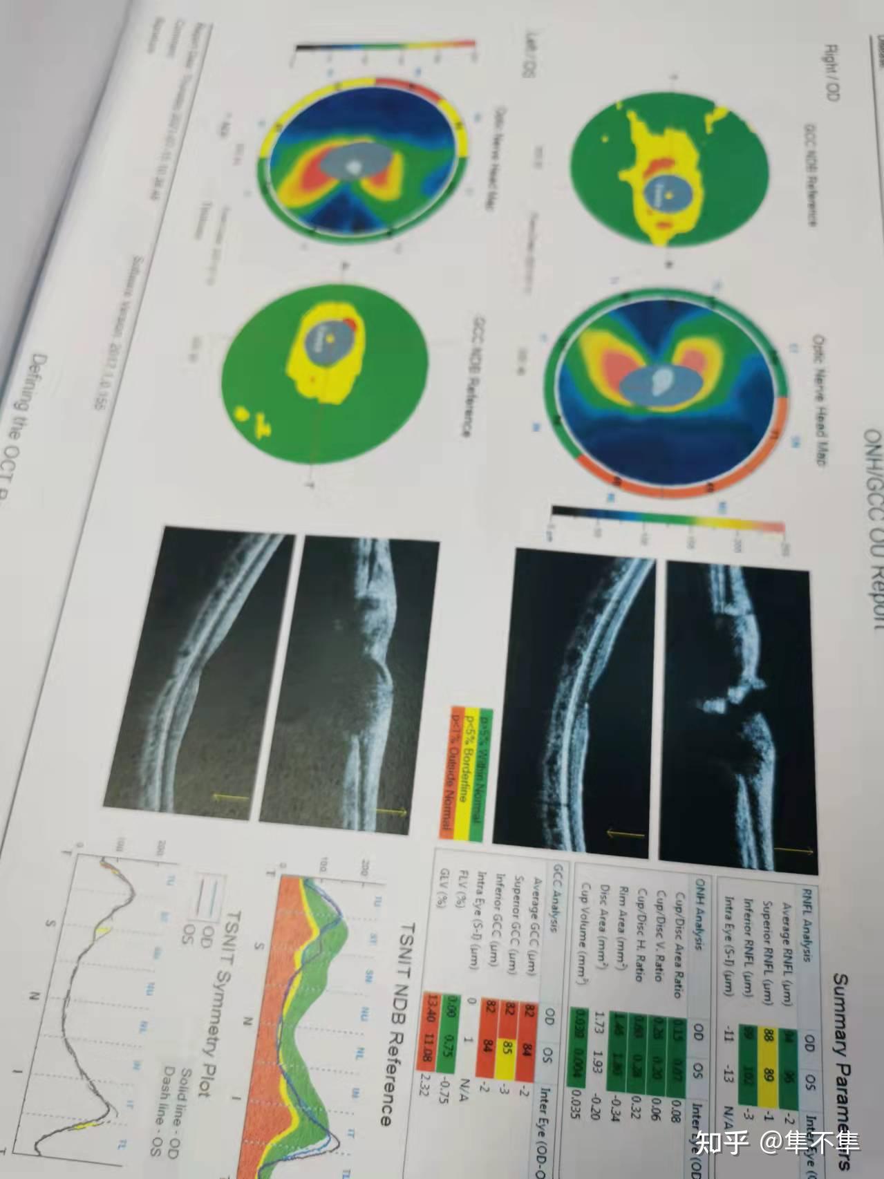 能记得住的:视力,眼压,裂隙灯检查,散瞳验光,眼底检查,角膜地形图,波