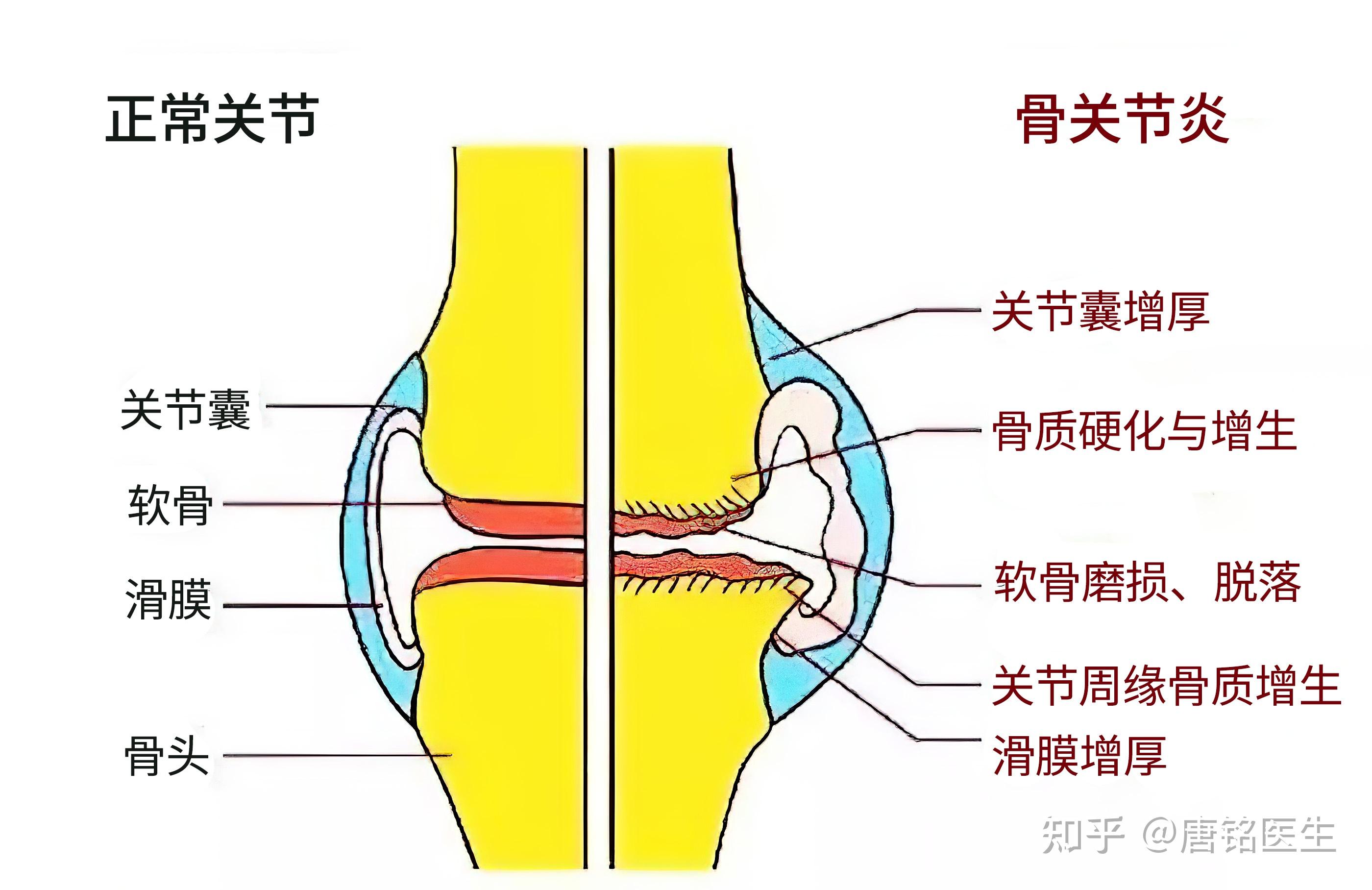 膝关节退变为何会痛?疼痛是不是唯一的危害?