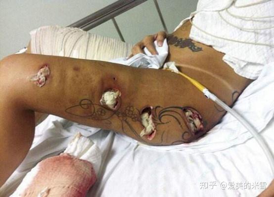 原因还是医生手术无菌操作不严格或者是自己术后卫生不到位造成了感染