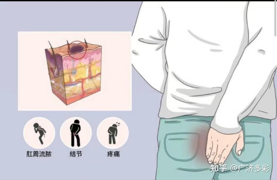腋下、肛周皮肤反复长包流脓，警惕化脓性汗腺炎 - 知乎