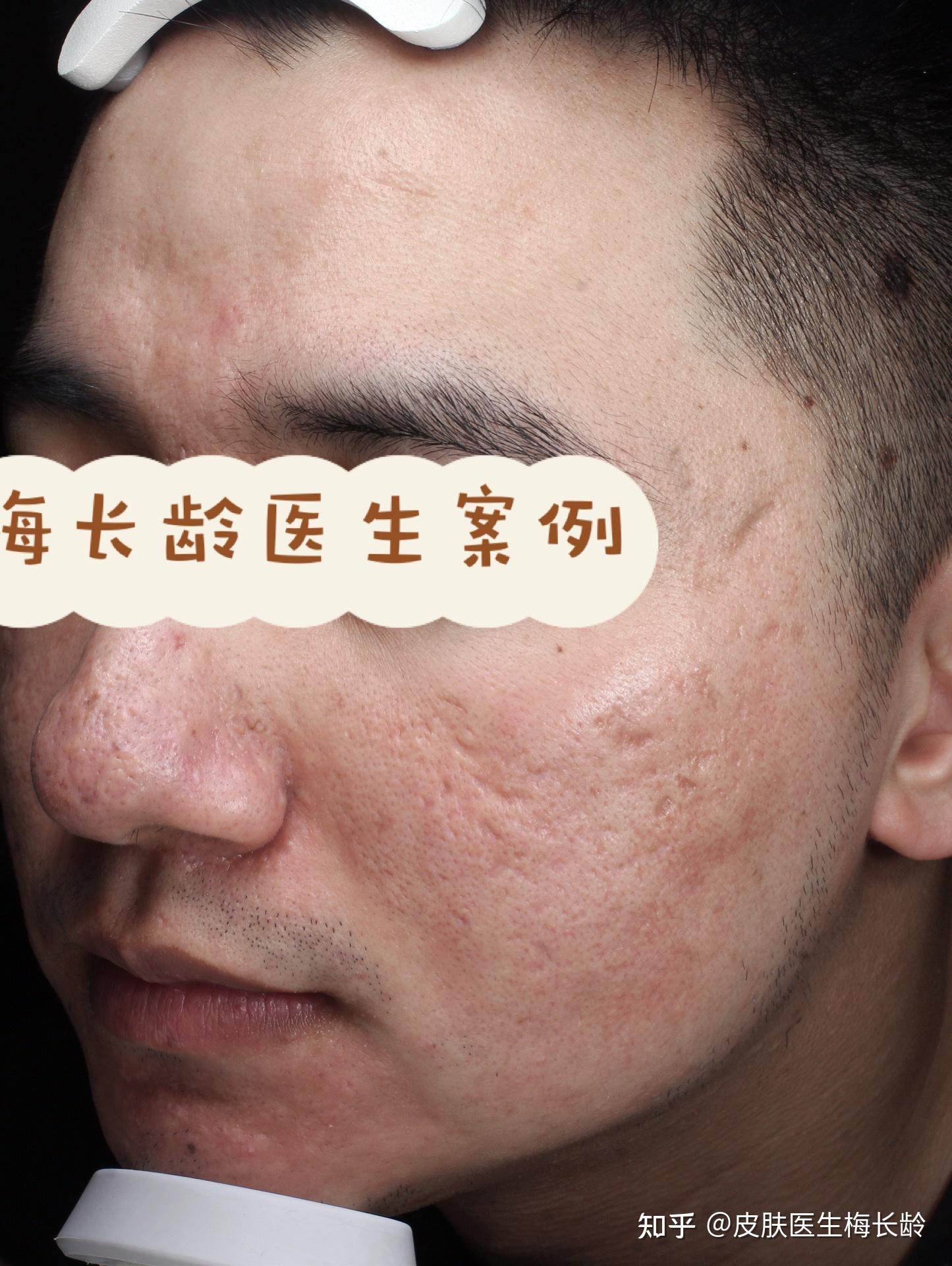 2020年至2021年两组半的综合激光修复痘坑对比