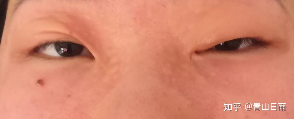 胆碱能性荨麻疹日记