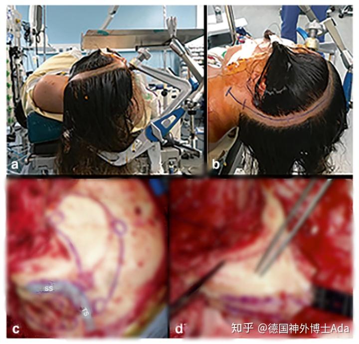 法国froelich教授图解脑膜瘤手术颞顶枕骨开颅联合岩骨切除