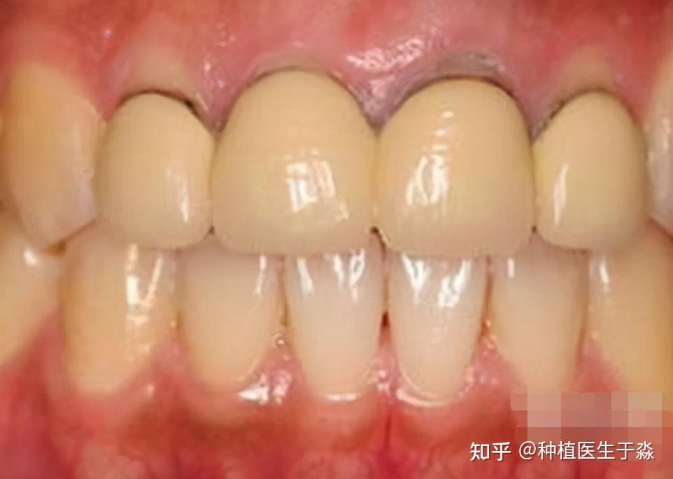 做了烤瓷牙后冠缘发黑了怎么办