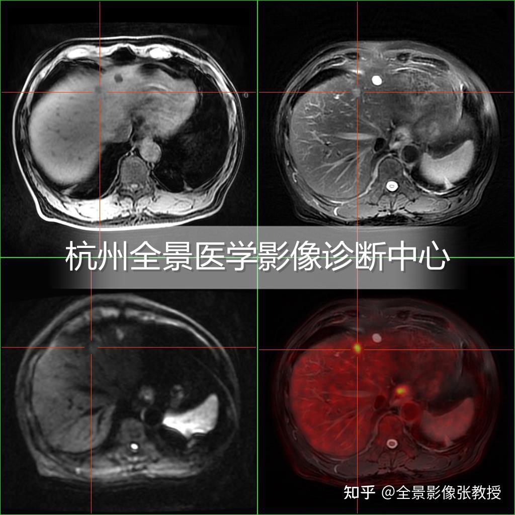 PET/MR在胃癌伴肝转移的案例分享 - 知乎
