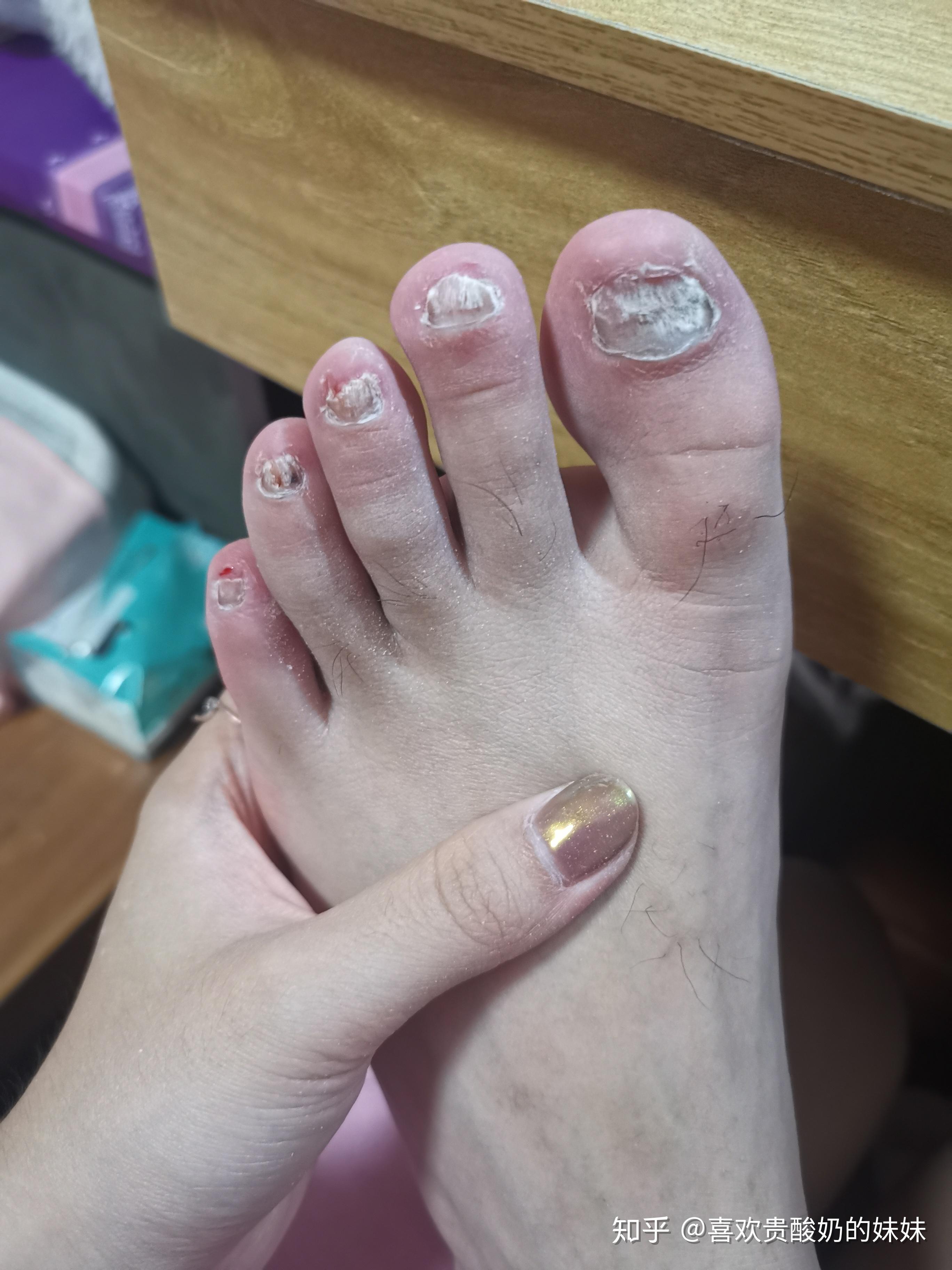 灰指甲治疗经历