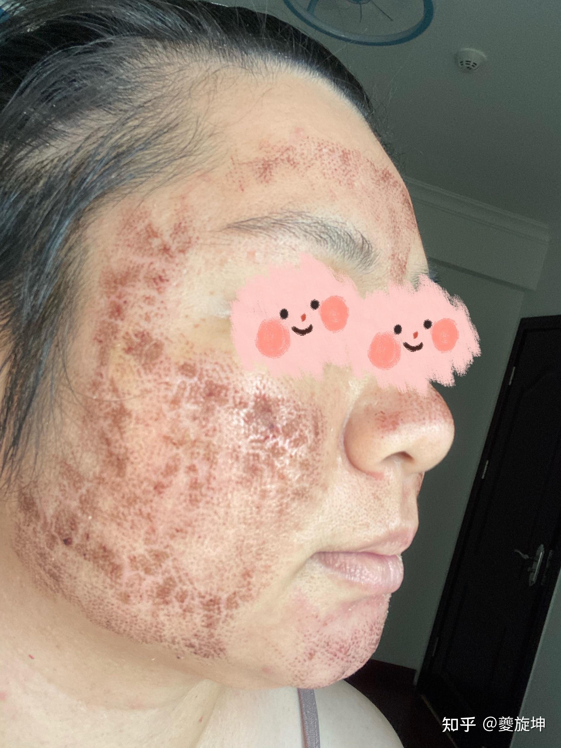 请问哪位坑友在医科大皮肤科做了离子束