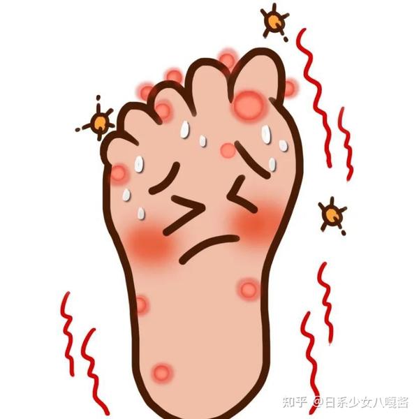 【珠海广肤】脚臭、脚痒、脚脱皮?你想了解的“足癣”干货都在这里! - 知乎