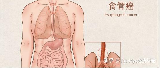 年纪轻轻，晚期食管癌是如何找上门的？一文解惑！ - 知乎
