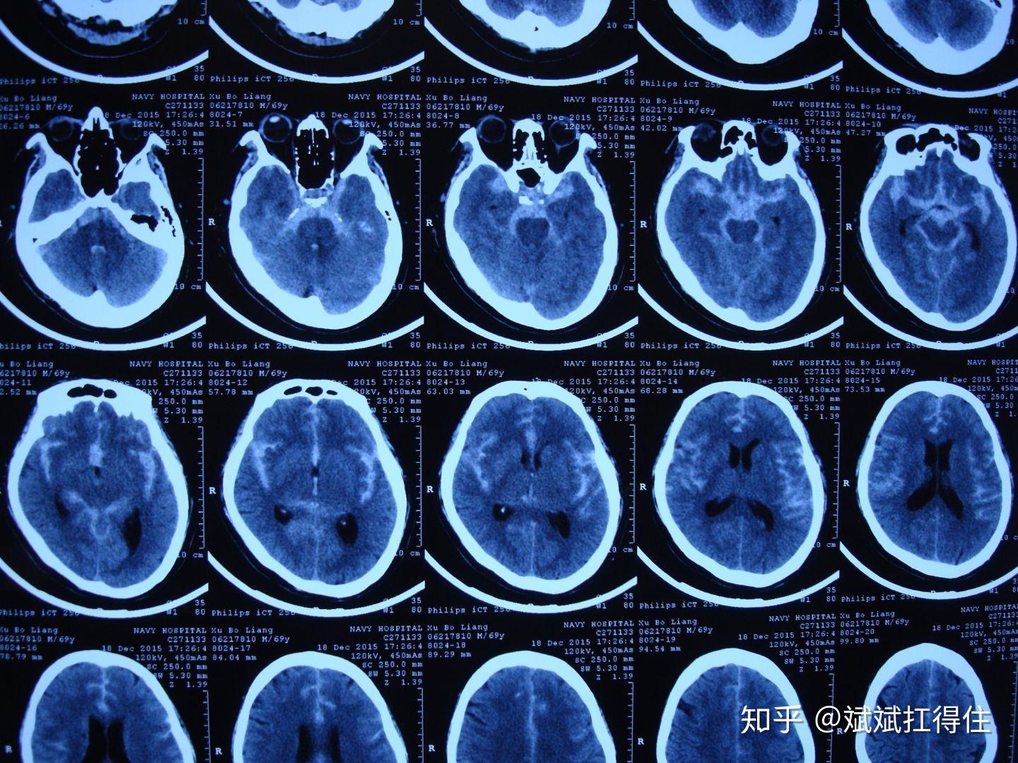 图1:蛛网膜下腔的ct表现图2:cta提示前交通动脉的动脉瘤图3:血管造影