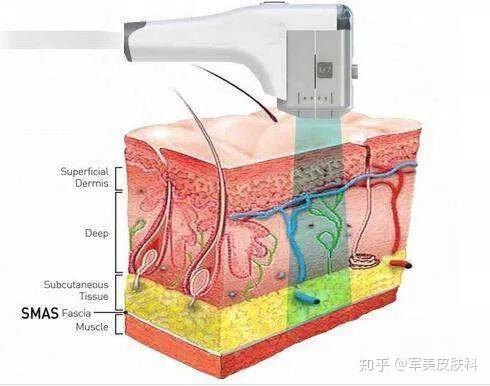 热拉提的原理_抗衰紧肤美容仪器好用吗 绿美涵 惠州抗衰紧肤美容仪器(3)