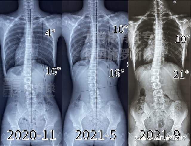 脊柱侧弯20多度什么样图片