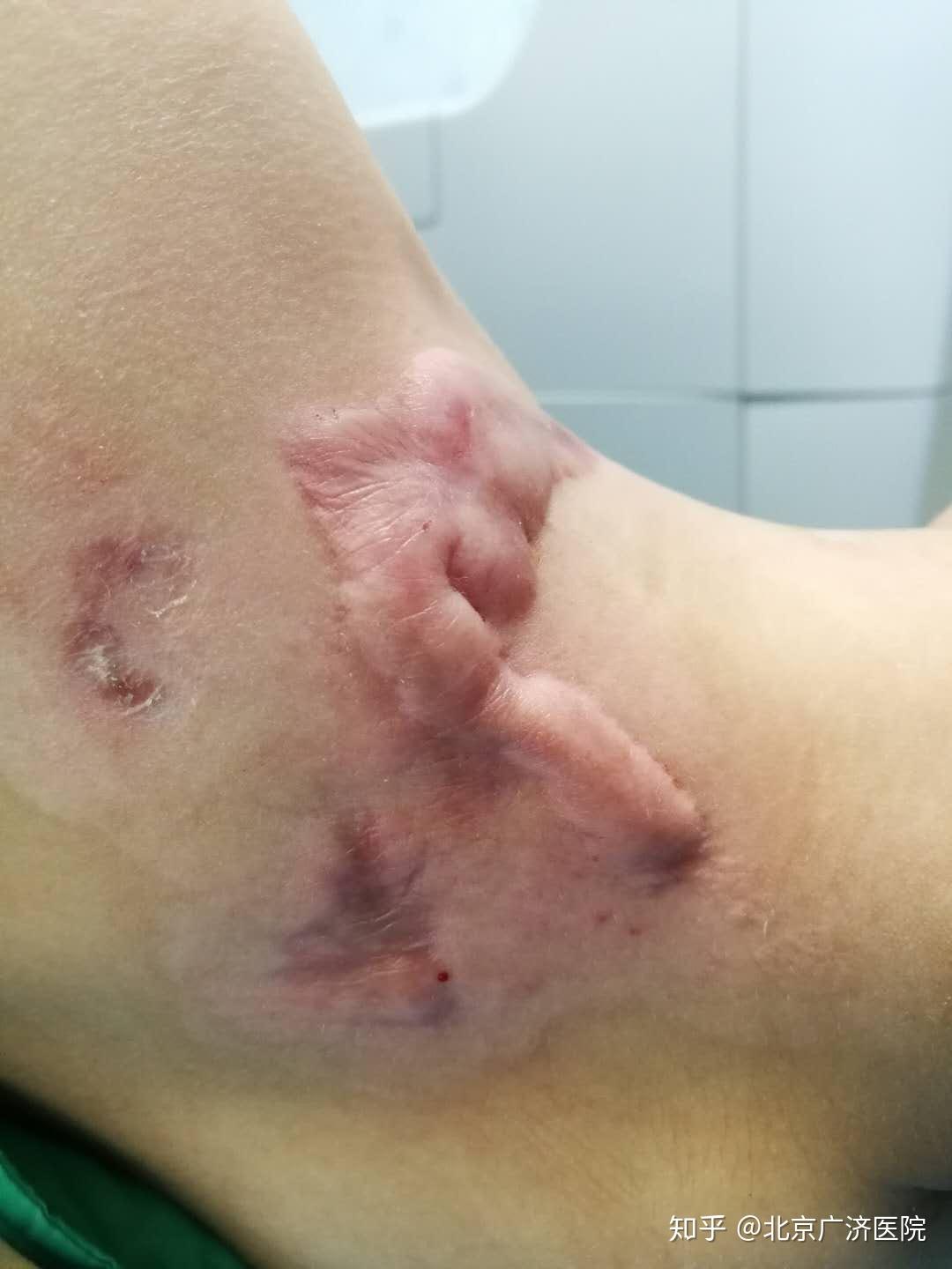 为什么受伤后疤痕有的凸起有的凹陷