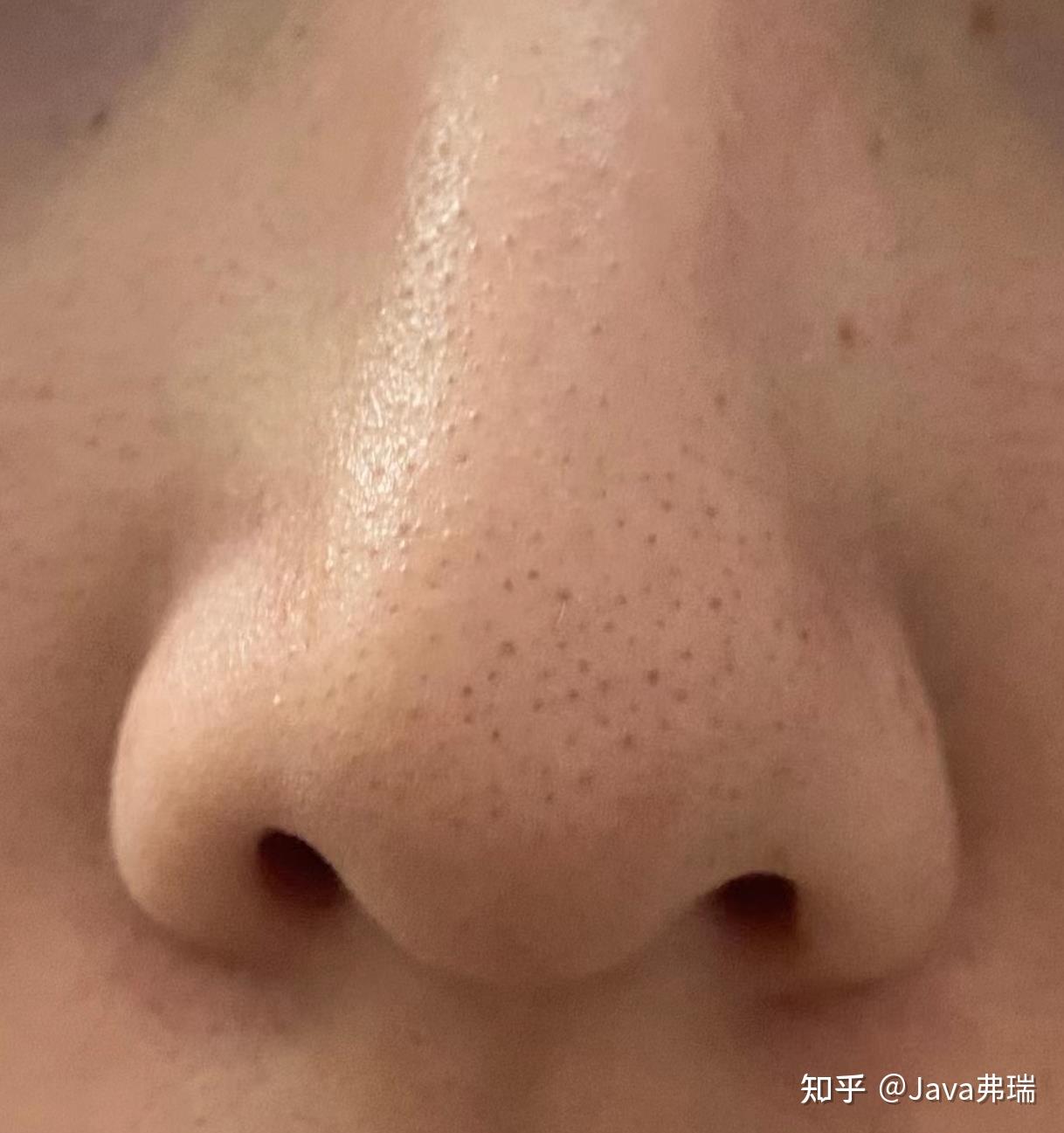 鼻子上黑头很多,有什么简单的方法可以完全祛黑头? - 知乎