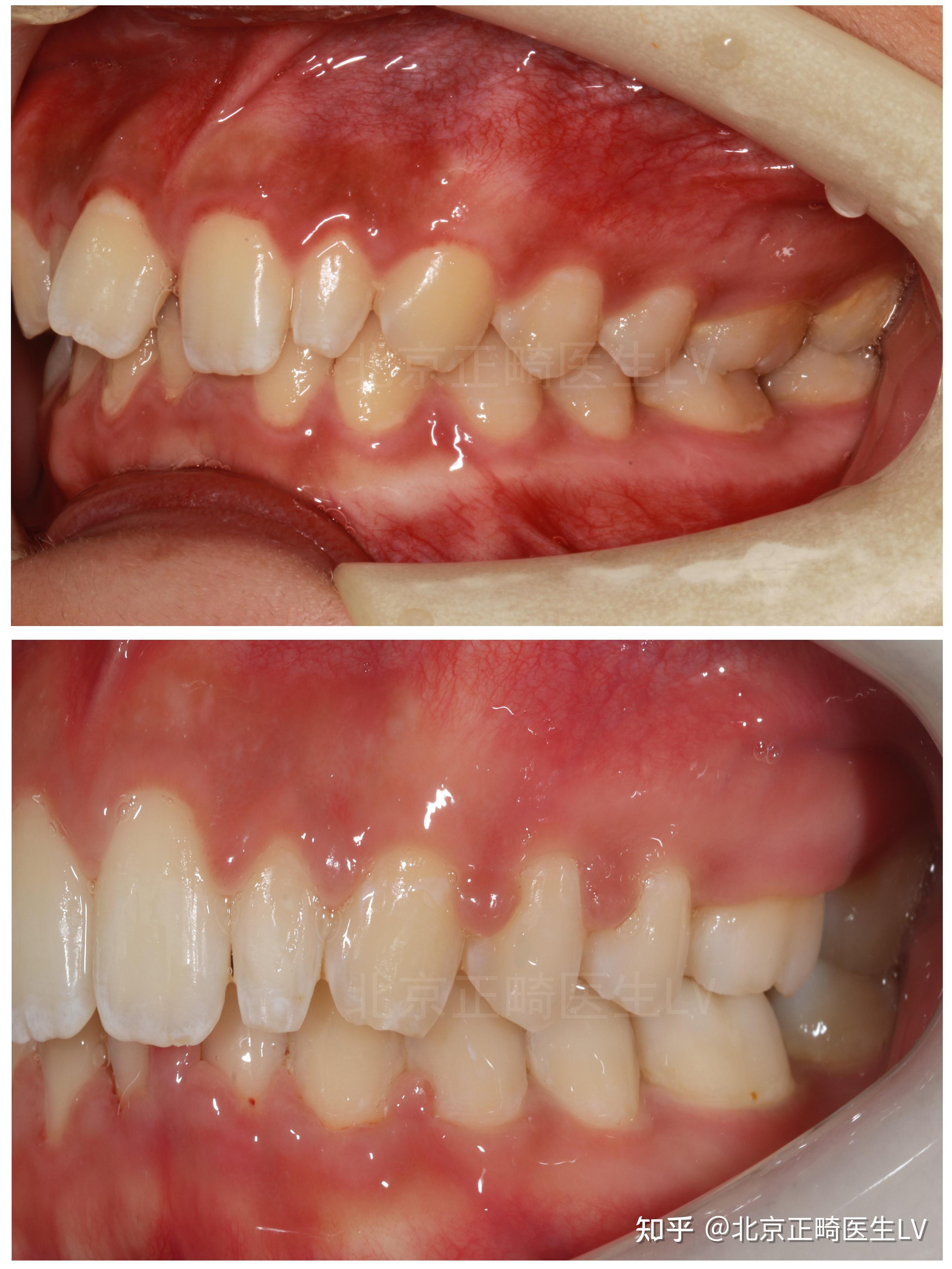 牙龈外翻图片
