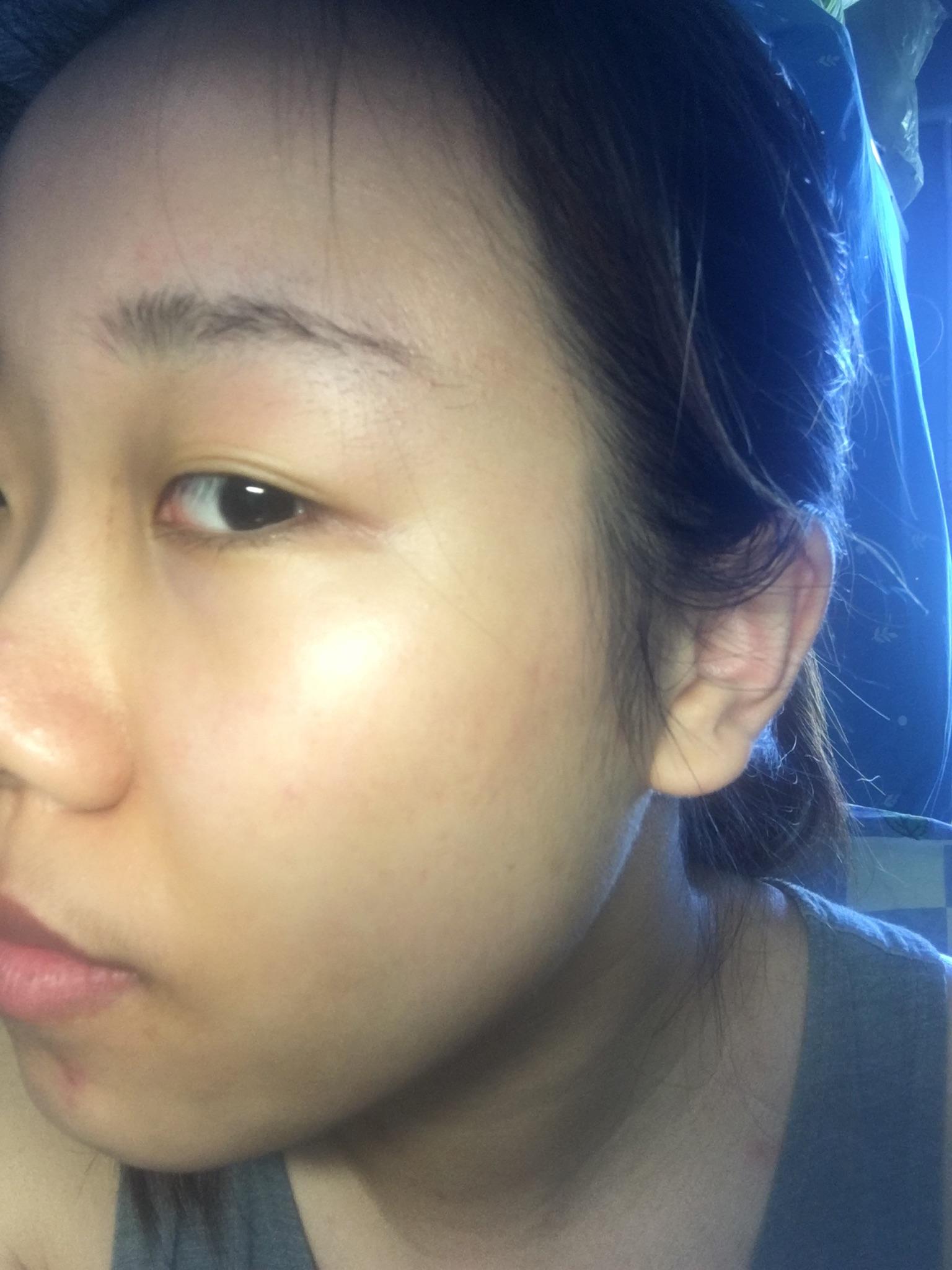 点阵激光 祛痘坑痘印