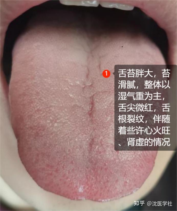 舌中裂纹越重,小心寿命越短!常见的4大裂纹舌,一次给你讲明白 - 知乎