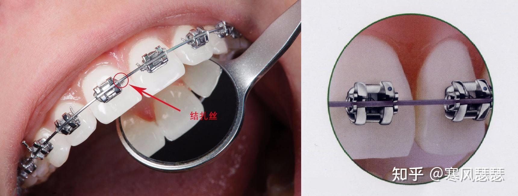 牙齿矫正的方式都有哪些?它们有什么异同?