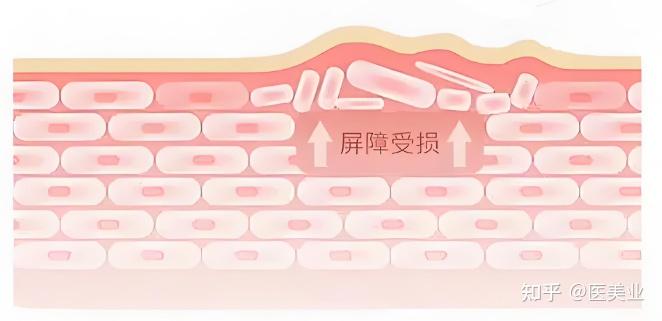 屏障修复过程有用的成分 - 知乎