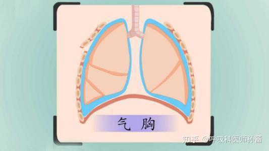 深受气胸困扰,中医可以帮助你 - 知乎