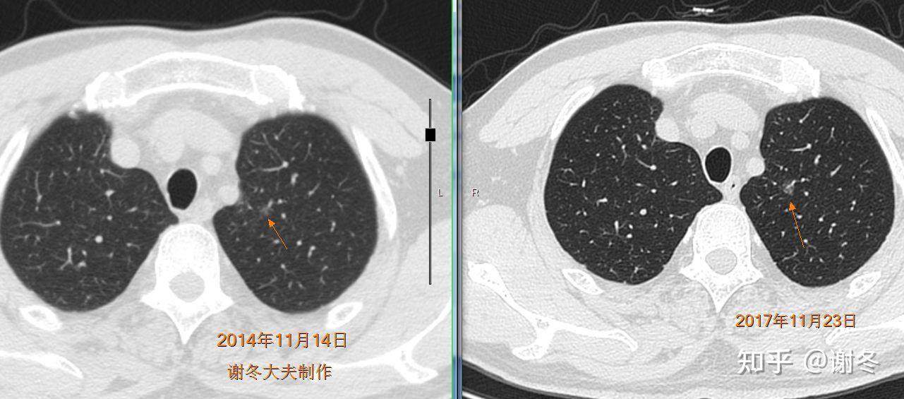 肺磨玻璃結節的生長速度如何會不會突然變成晚期肺癌