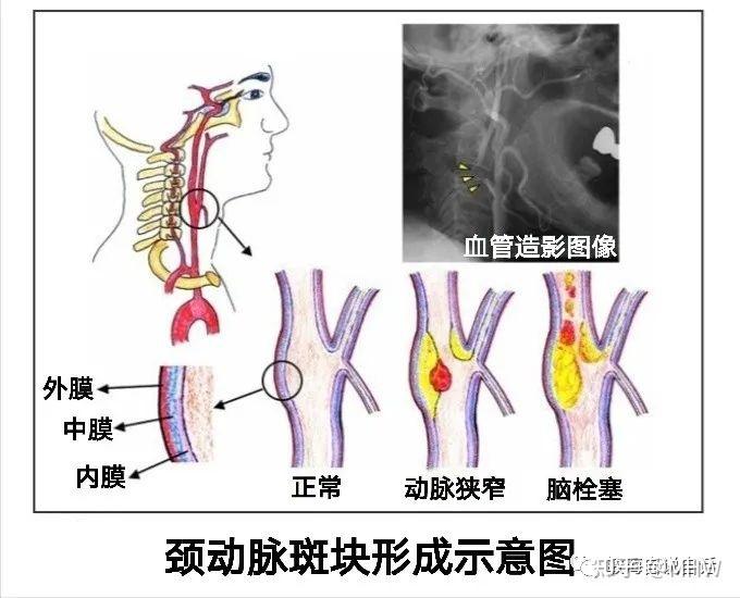 颈动脉斑块图片及说明图片