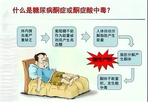 健康科普 | 一文看懂糖尿病酮症酸中毒 - 知乎