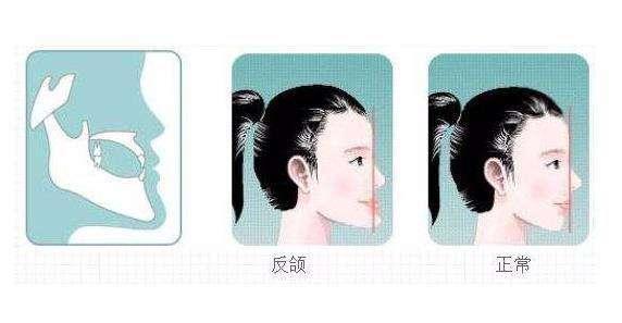 牙齿正畸类型大赏|偏颌、反合、开合 - 知乎