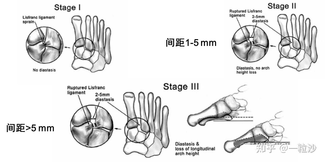 injuries)即lisfranc 损伤,是指跖跗关节和楔间关节的骨质或韧带损伤