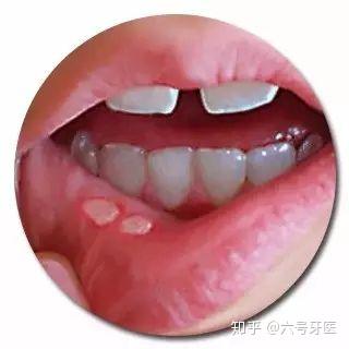 口腔溃疡什么样子 zhuanlan.zhihu.com