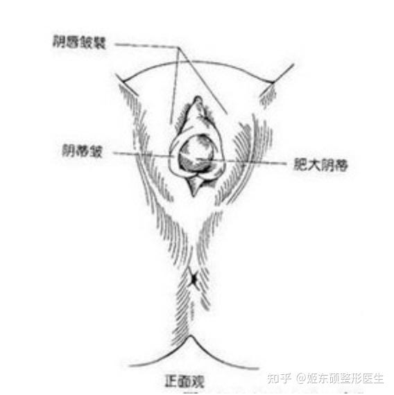 三,阴蒂肥大和阴蒂包皮肥大