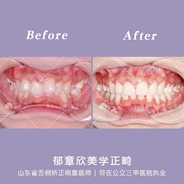 青岛牙齿矫正：美学正畸 | 嘴凸+牙齿拥挤不齐，调整笑弧笑线，收获饱满笑容 - 知乎