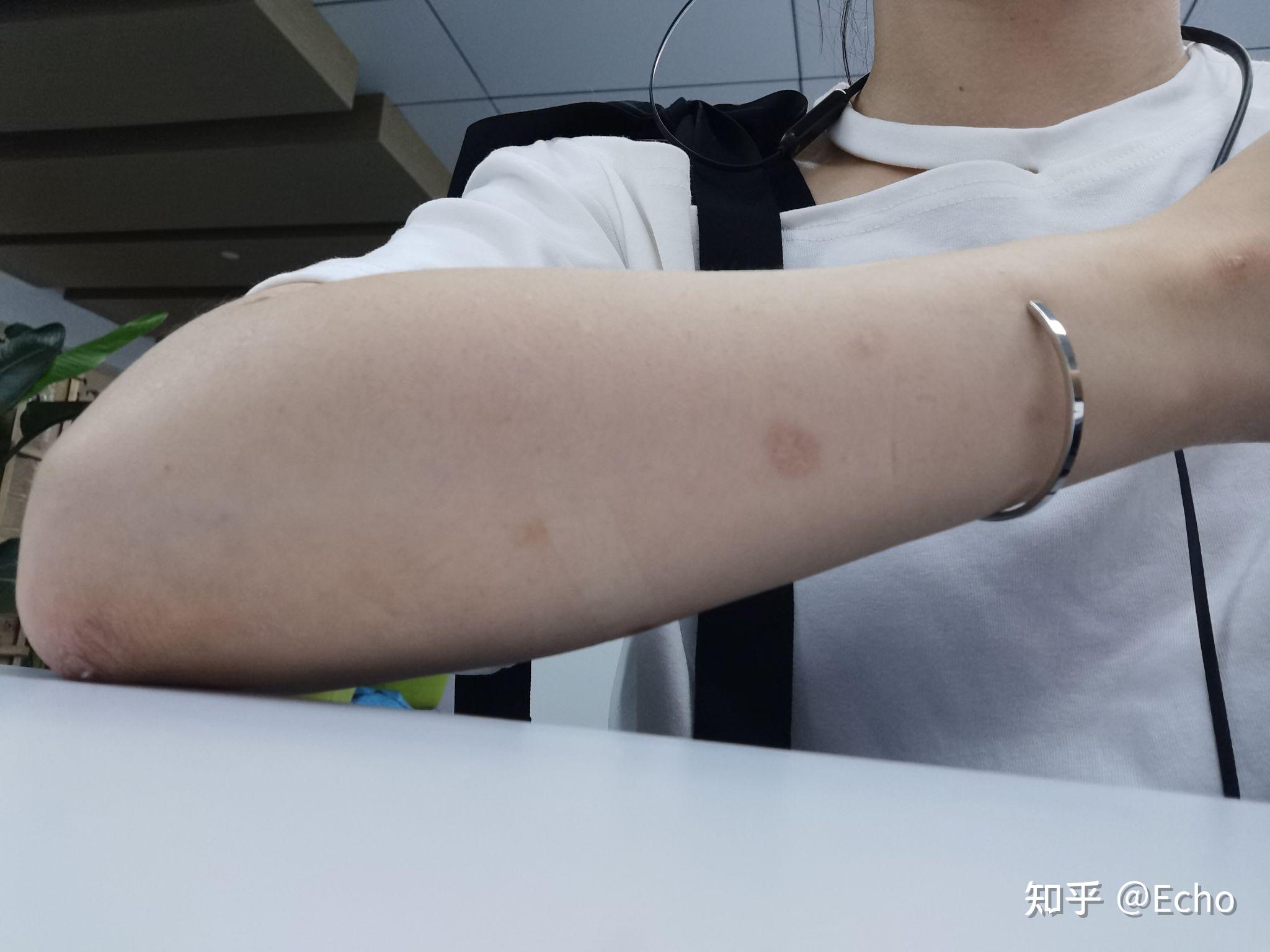 手臂上长了疣 - 知乎