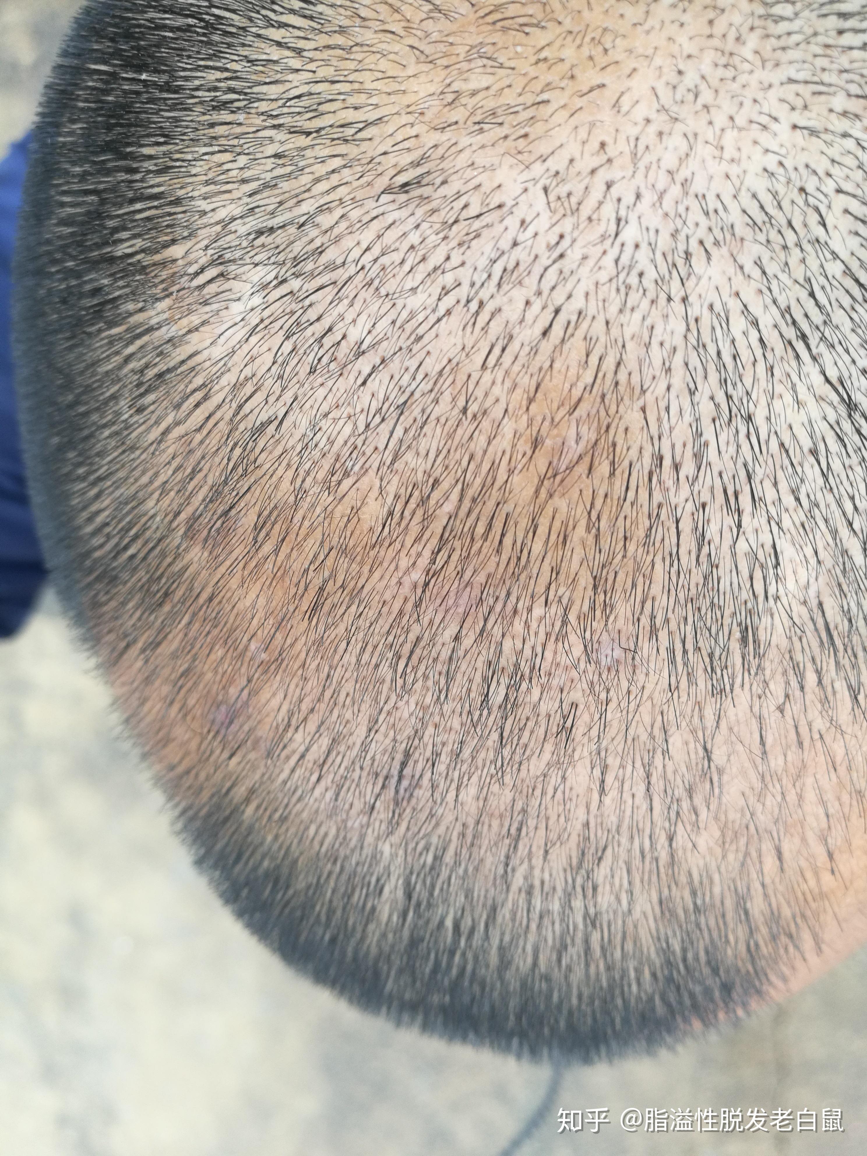 男性脂溢性脱发恢复一年的效果展示