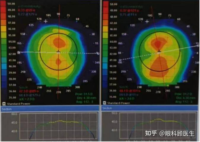 角膜地形图es值em值图片