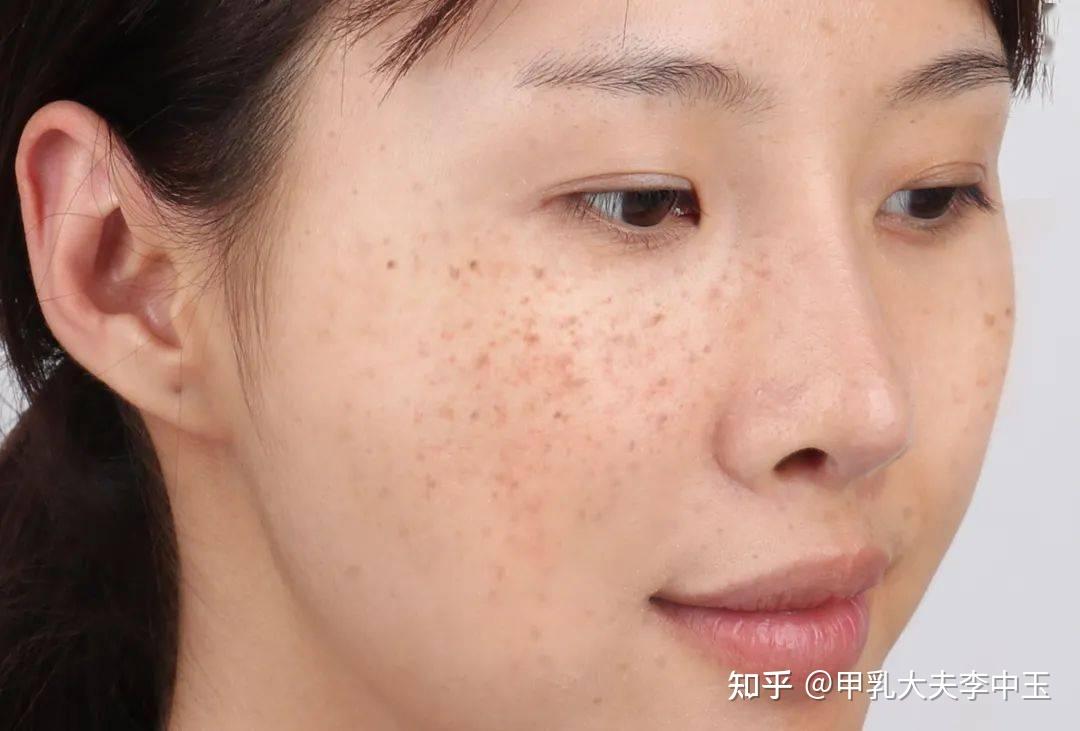 女人脸上长斑怎么办试试这些食疗方法