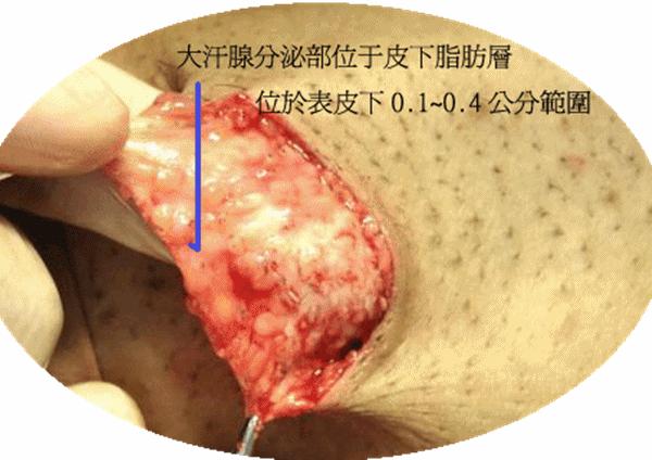 做了狐臭手术现在腋下臭怎么办