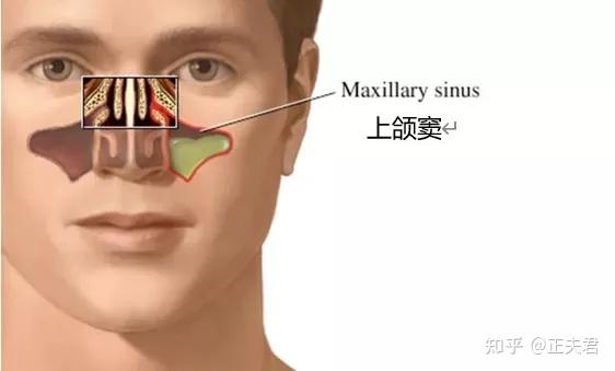 種一顆牙為什麼這麼麻煩上頜竇內提升究竟是什麼