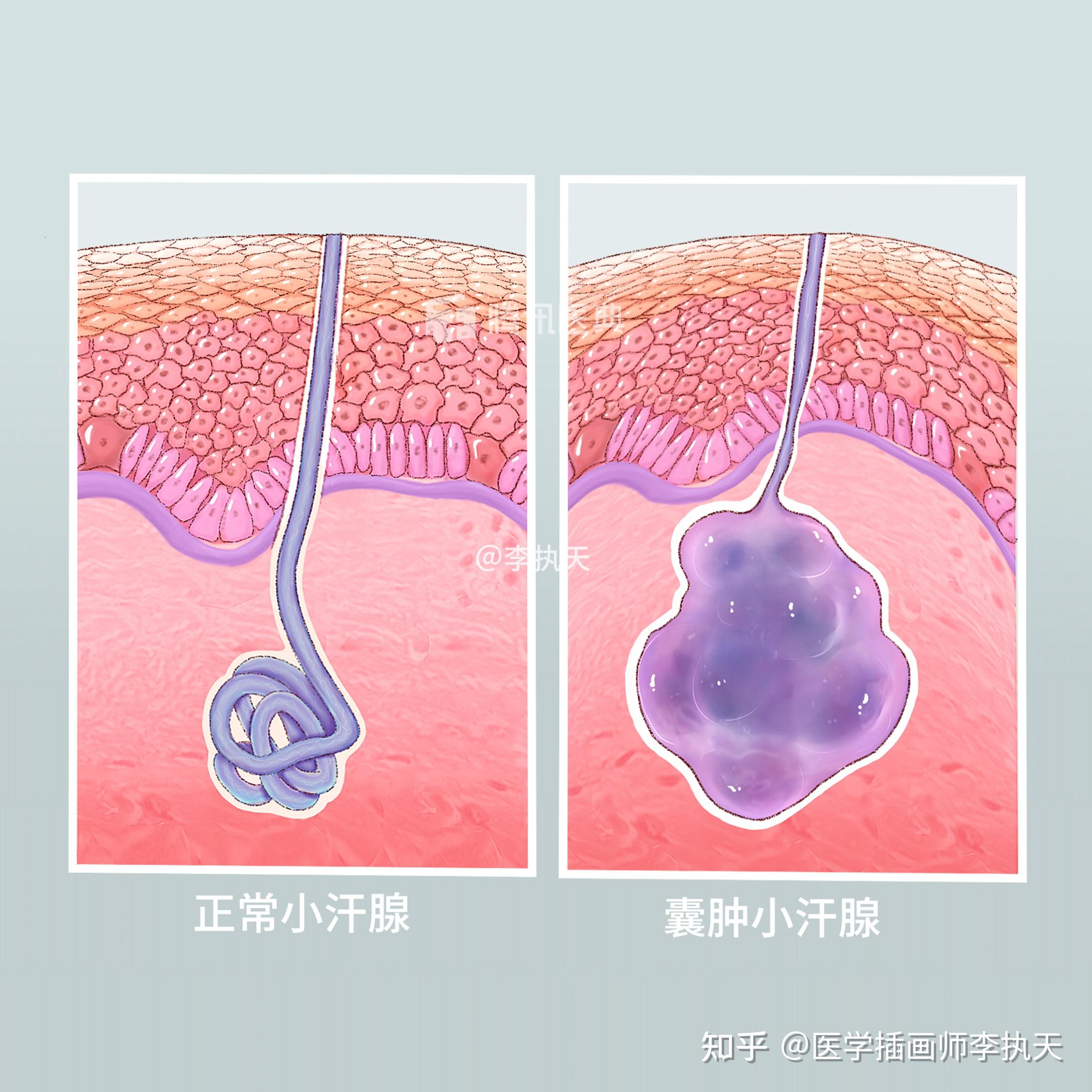 小汗腺汗囊腫支氣管惡性腫瘤may-thurner綜合徵靜脈血栓形成以上是我