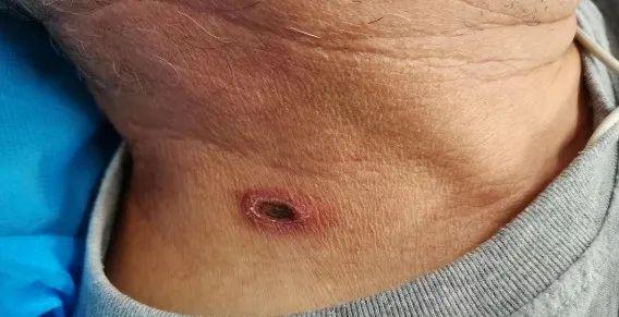 中央结成黑痂,呈圆形或椭圆形,直径为1-15毫米——恙虫病独一无二的