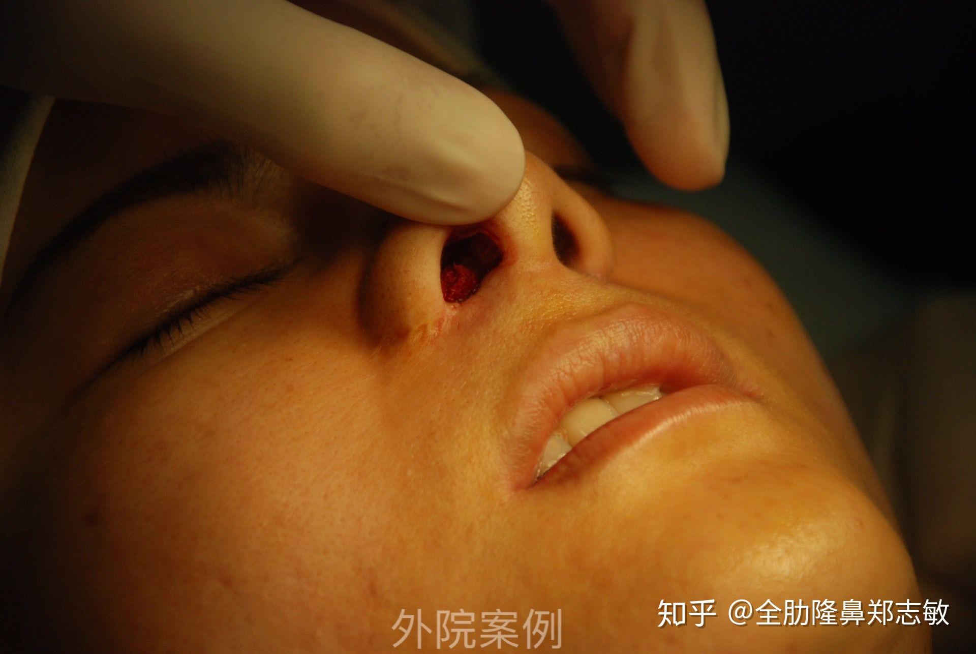 外切鼻翼会留疤吗