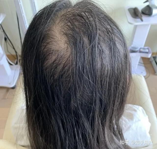三年养发经历大曝光!原来发量暴增只需短短30天,仅发一次,赶紧收藏! - 知乎
