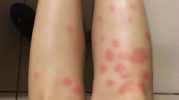 被跳蚤咬了怎么办?